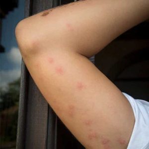 picaduras de chinches