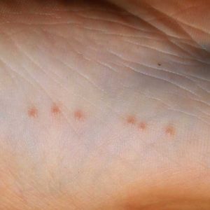 síntomas de una alergia a las picaduras de chinche